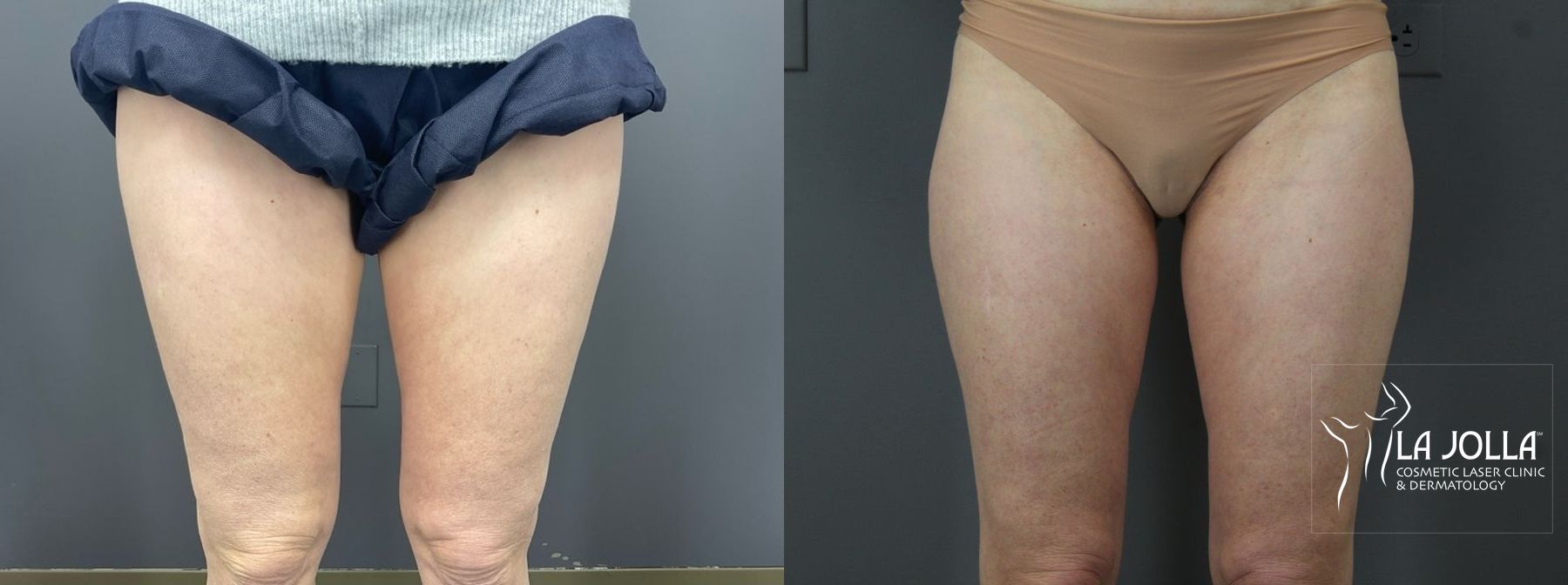Before and after Thermage case 36159