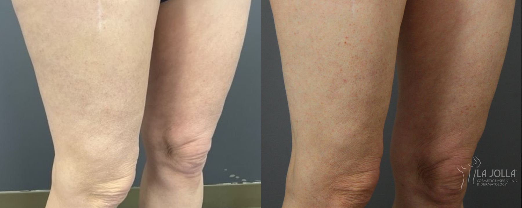 Before and after Thermage case 36159 - Angle 3