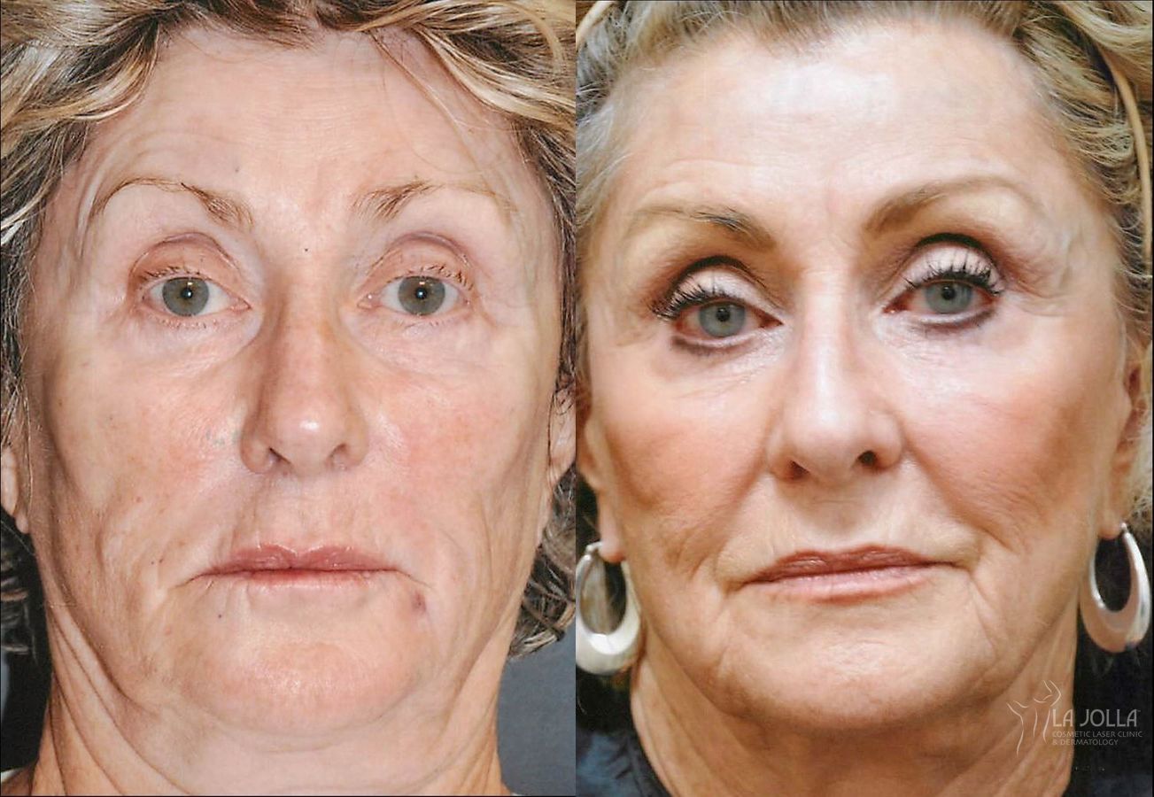 Before and after Thermage case 36250