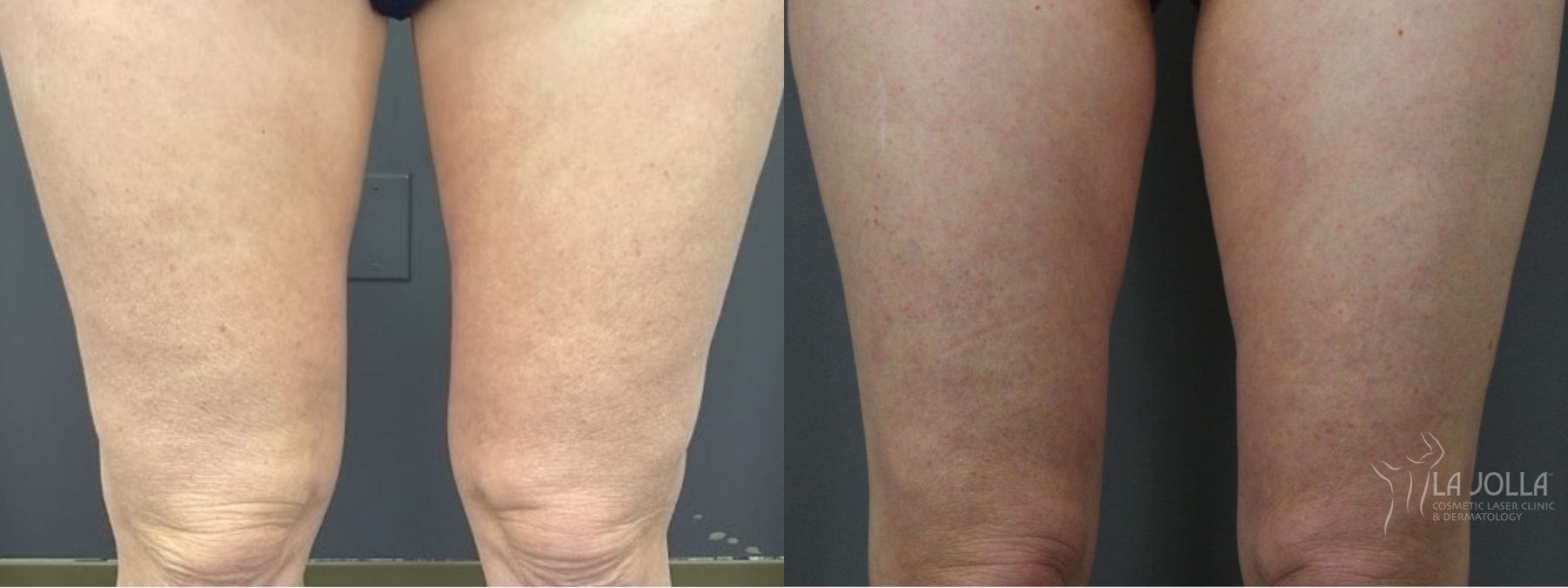 Before and after Thermage case 36159