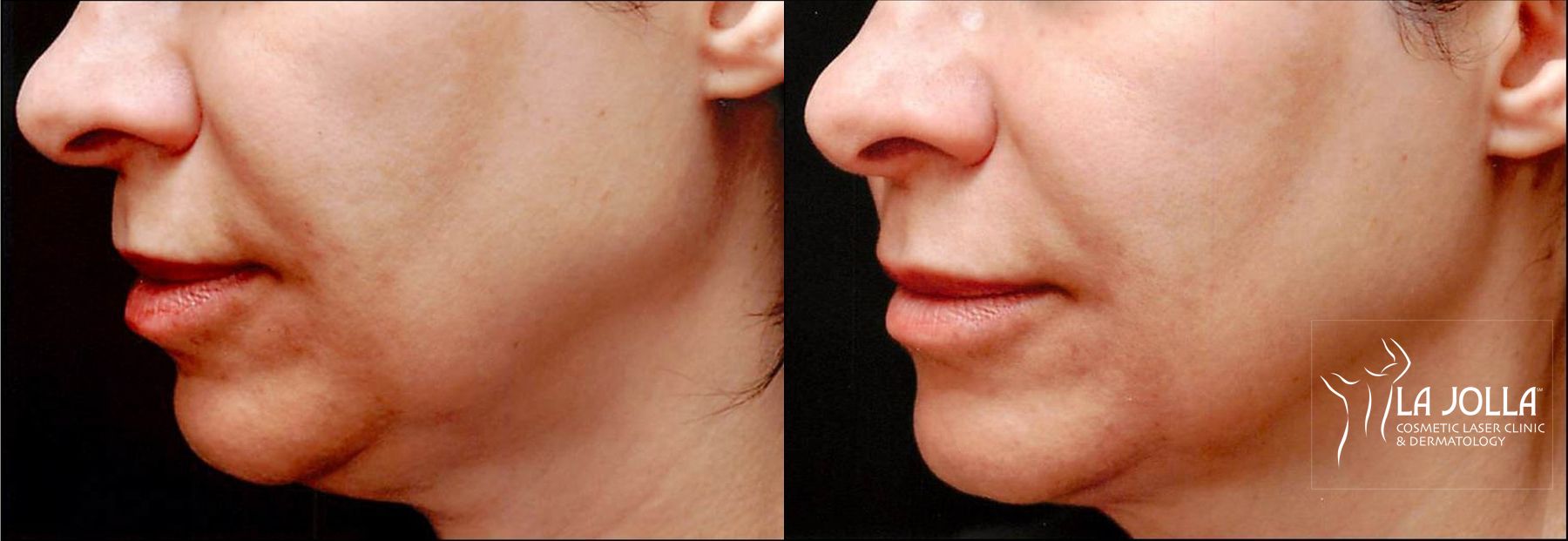 Before and after Thermage case 36246