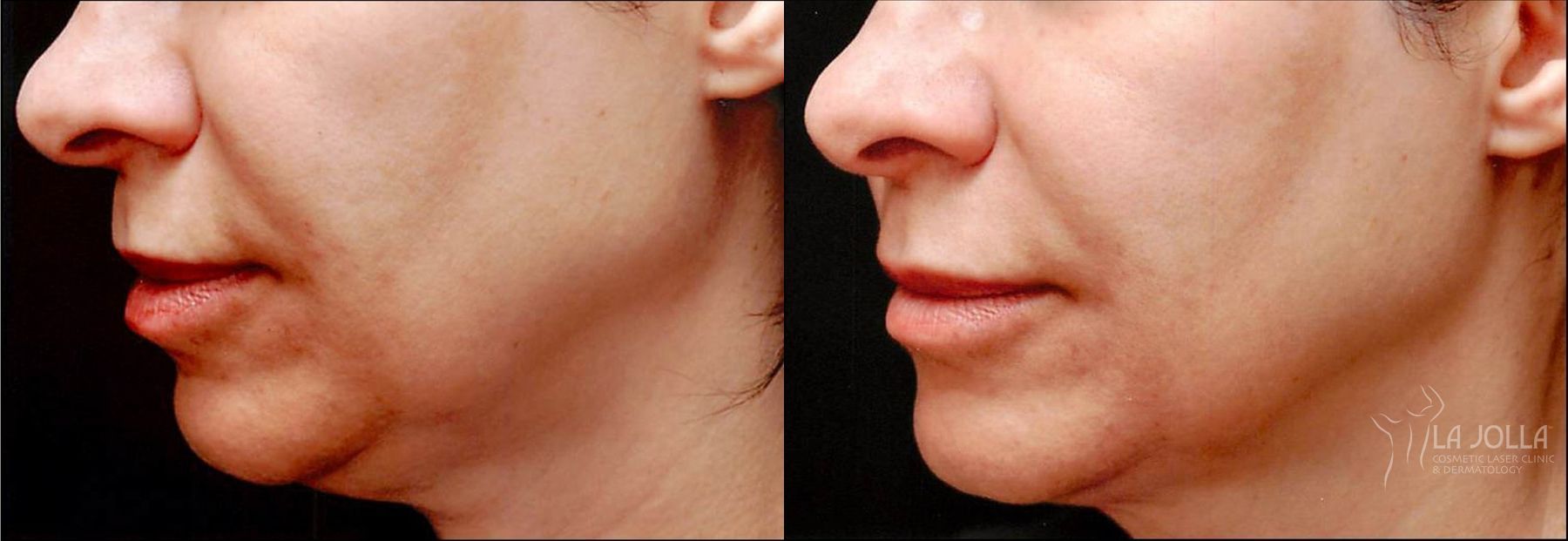 Before and after Thermage case 36246