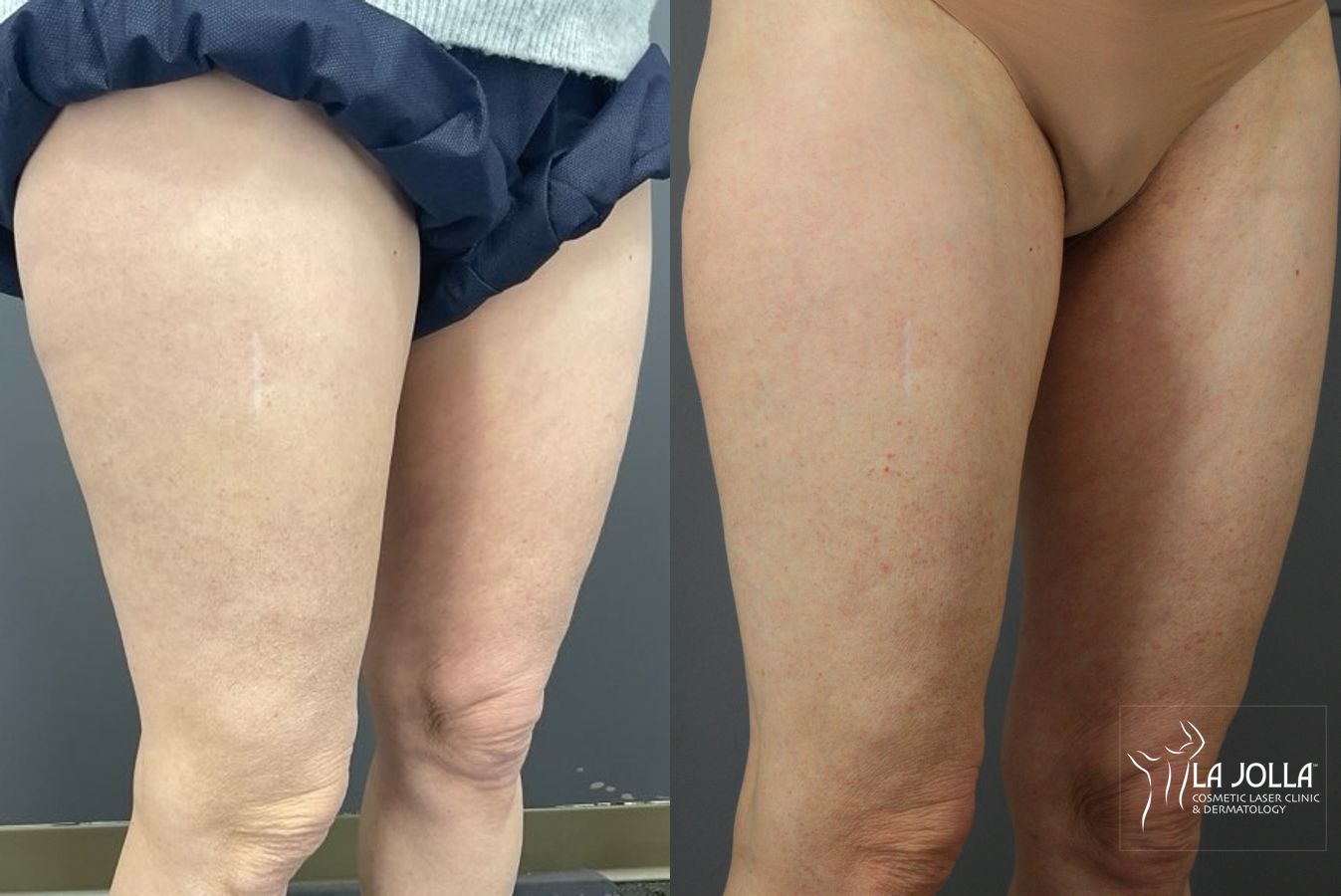 Before and after Thermage case 36159 - Angle 3
