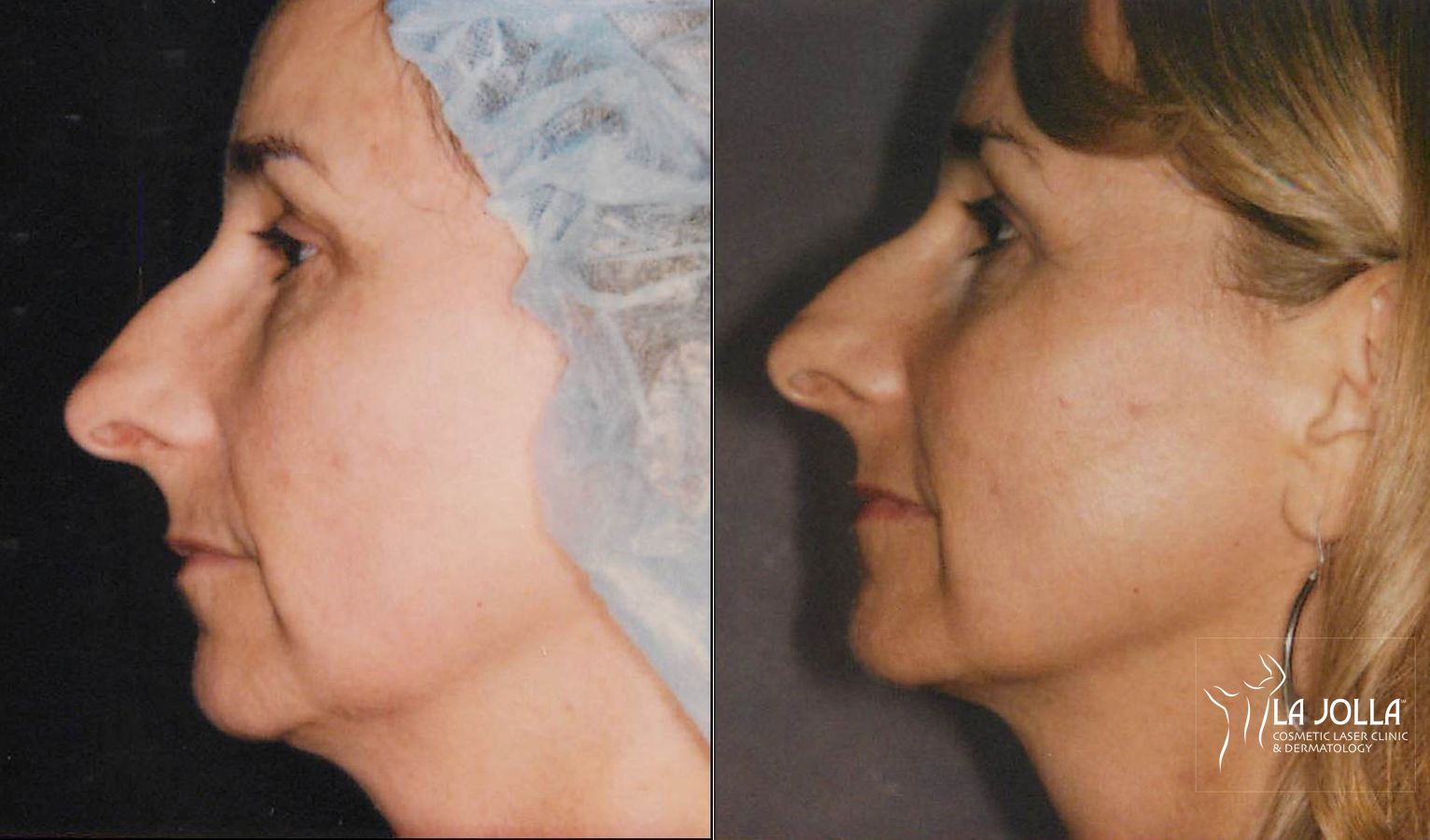 Before and after Thermage case 36207