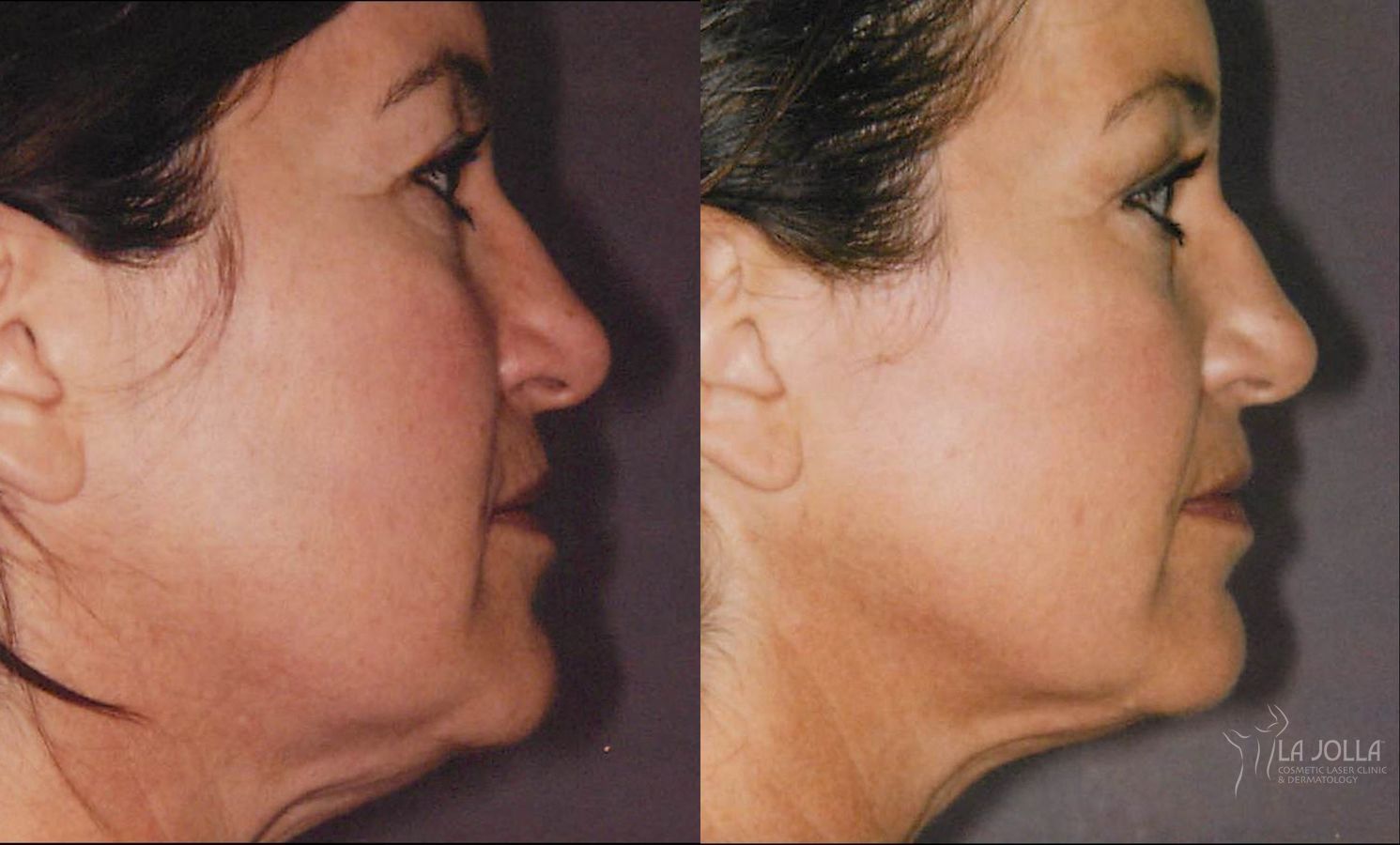 Before and after Thermage case 36226