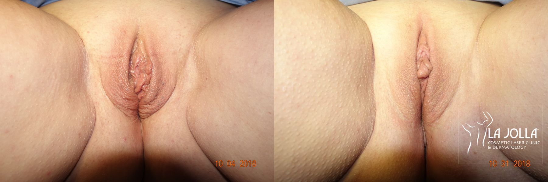 Before and after ThermiVa® case 36411