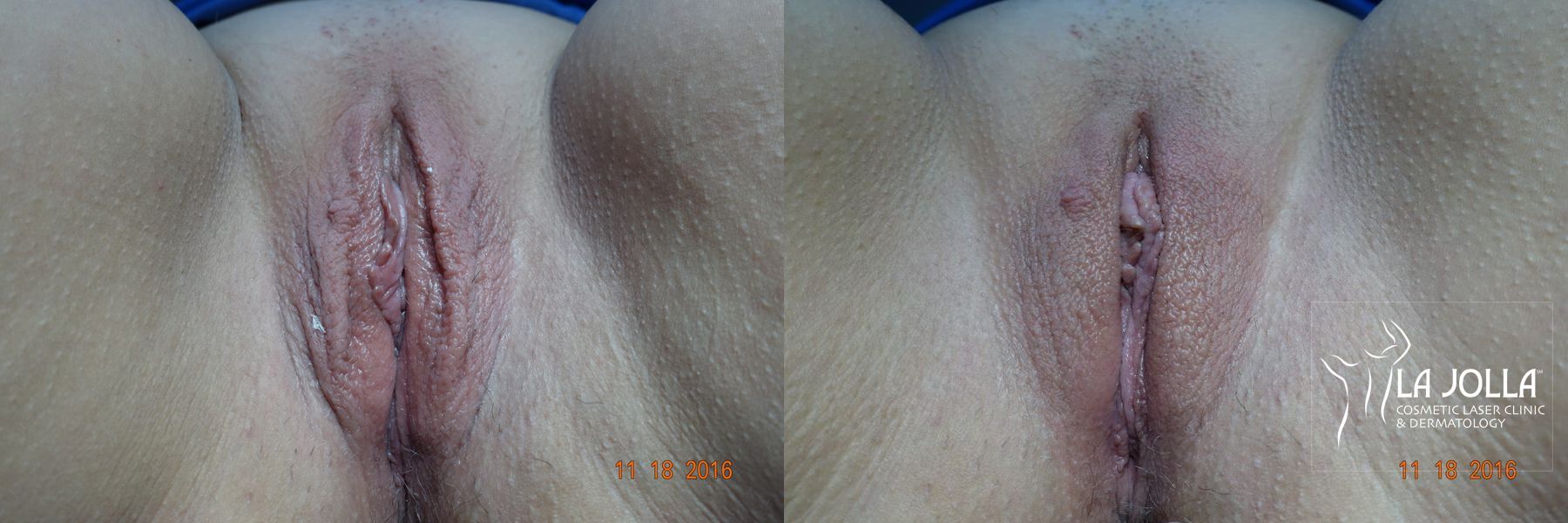 Before and after ThermiVa® case 36419
