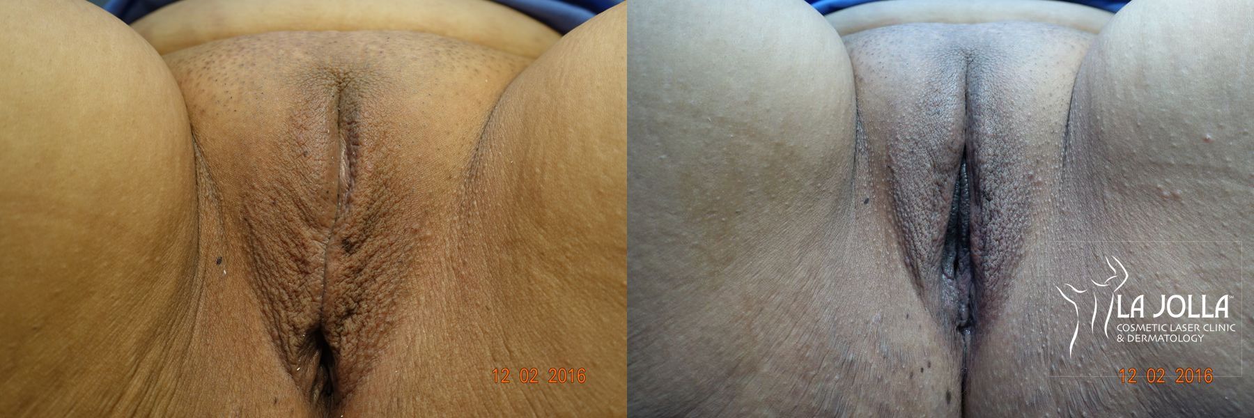Before and after ThermiVa® case 36421