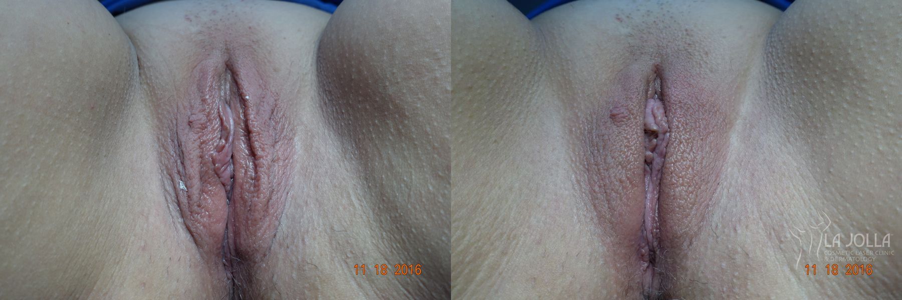 Before and after ThermiVa® case 36419