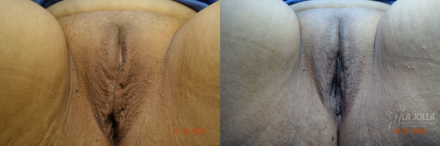 Before and after ThermiVa® case 36421