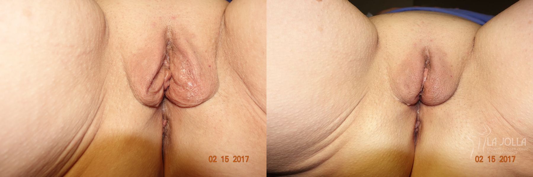 Before and after ThermiVa® case 36420
