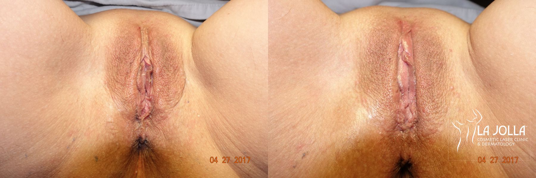 Before and after ThermiVa® case 36416