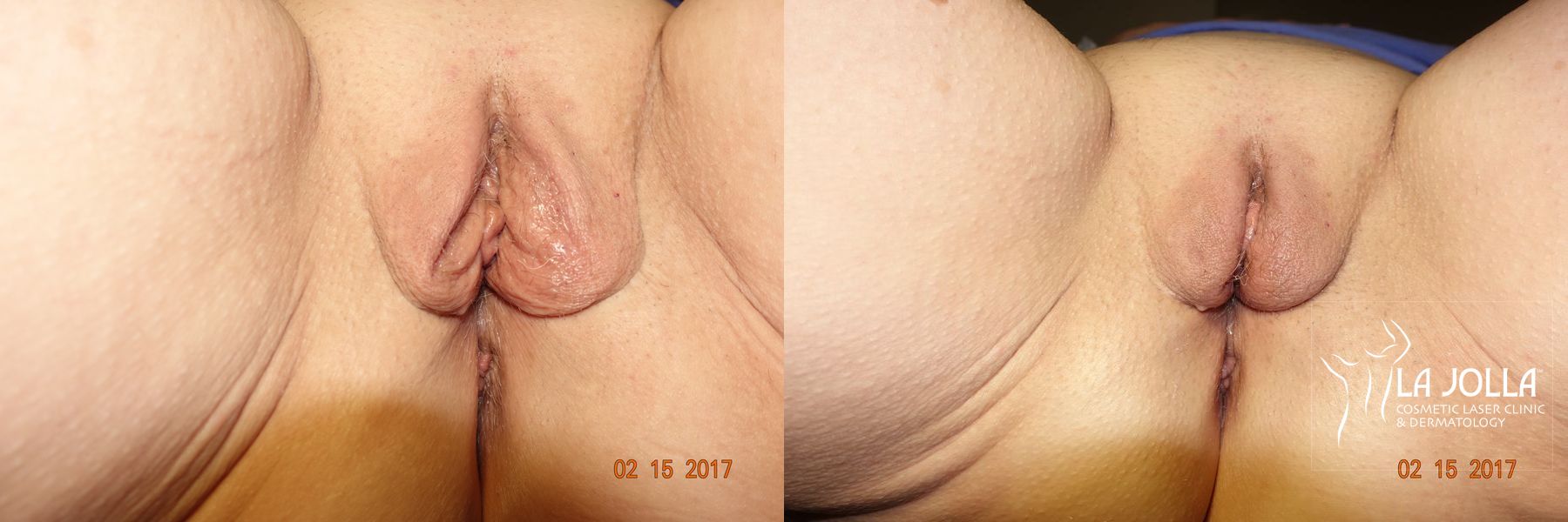 Before and after ThermiVa® case 36420