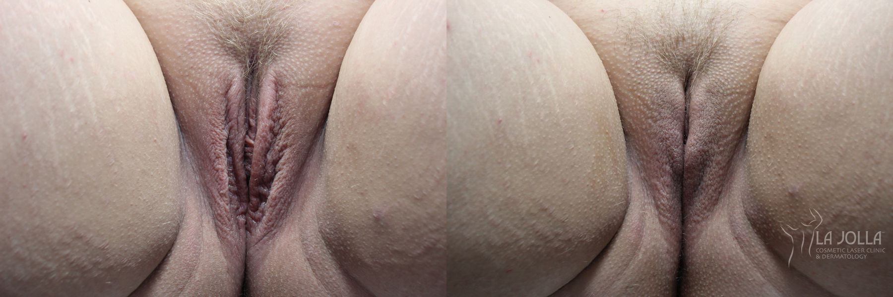Before and after ThermiVa® case 36413