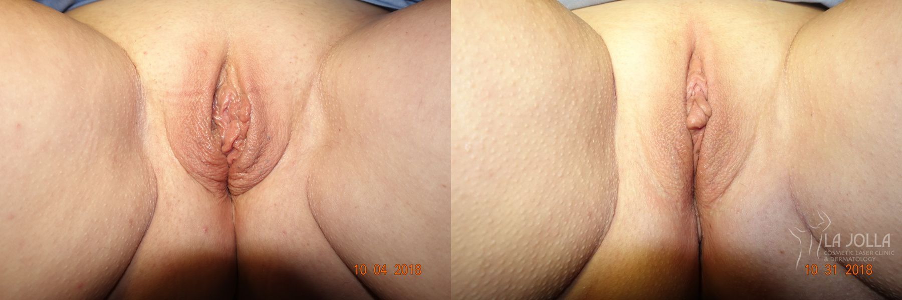 Before and after ThermiVa® case 36411