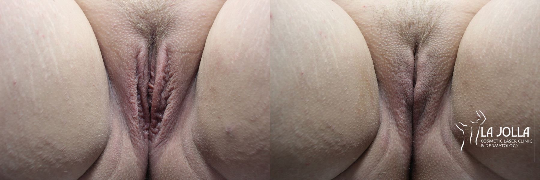 Before and after ThermiVa® case 36413