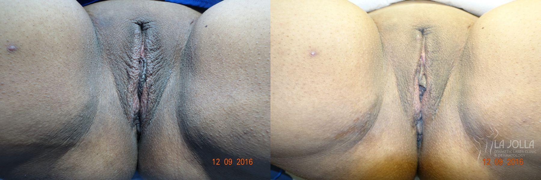 Before and after ThermiVa® case 36423