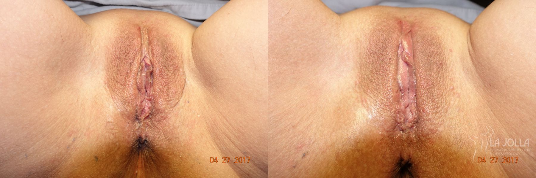 Before and after ThermiVa® case 36416