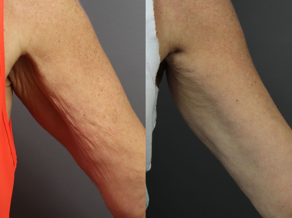Before and after TightSculpting case 36199 - Angle 2
