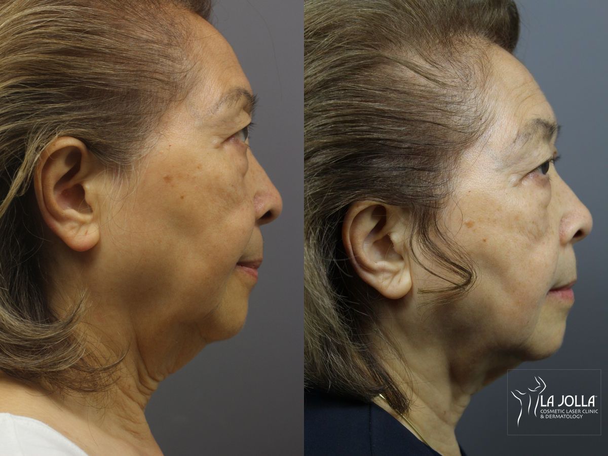 Before and after Ultherapy® case 36147