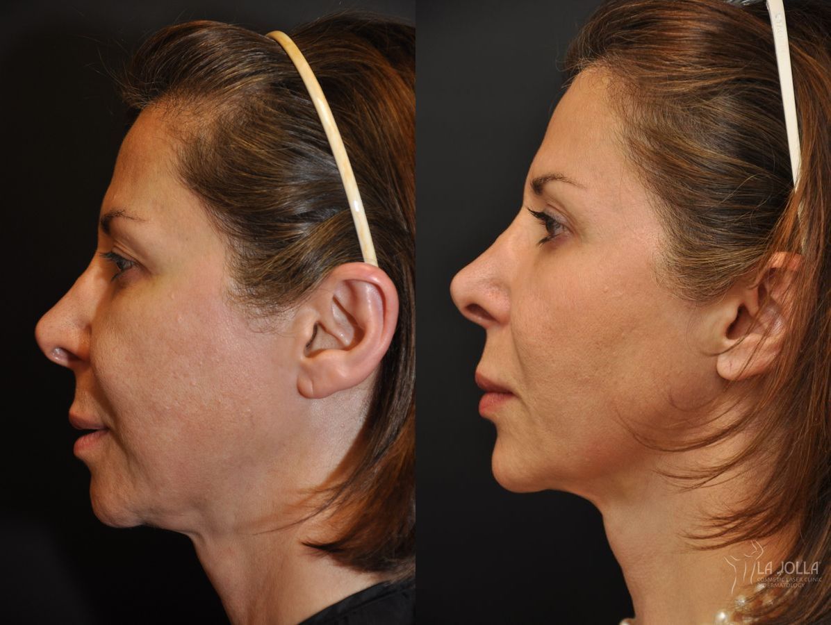 Before and after Ultherapy® case 36175