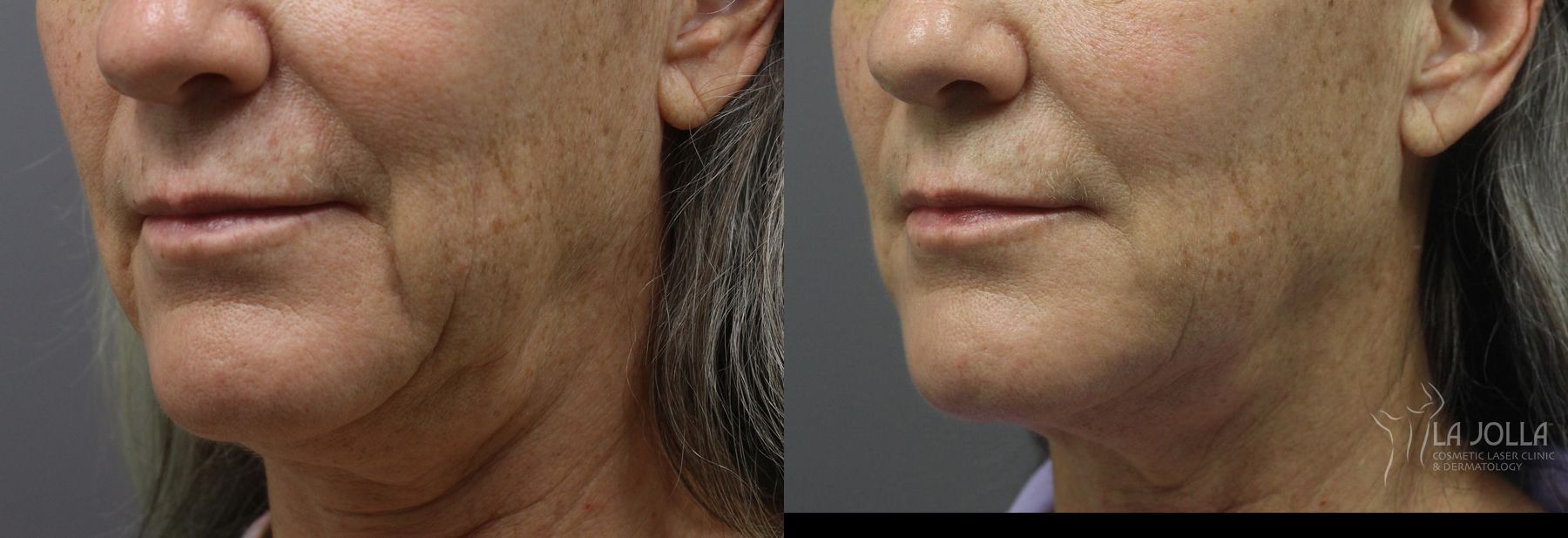Before and after Ultherapy® case 36229