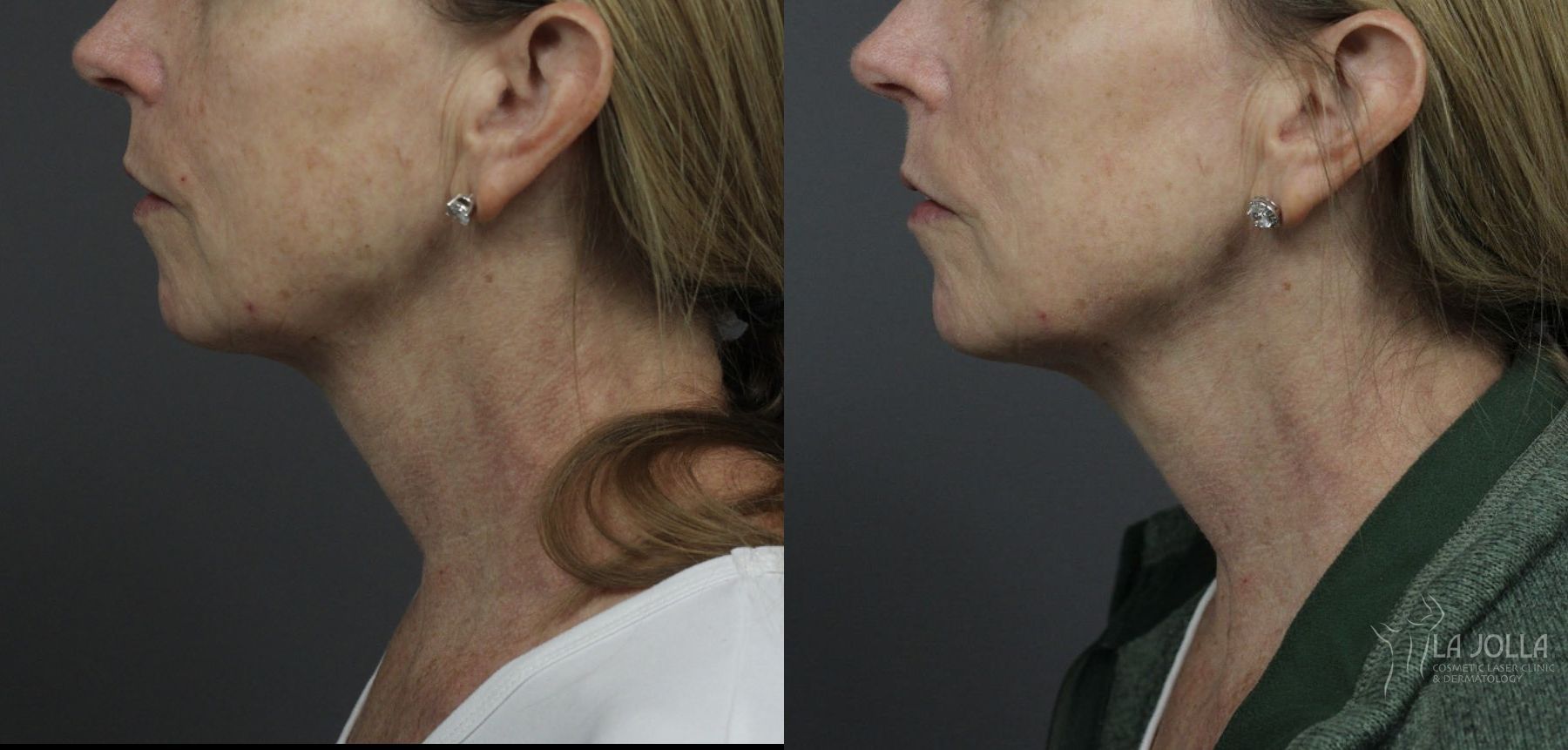 Before and after Ultherapy® case 36105