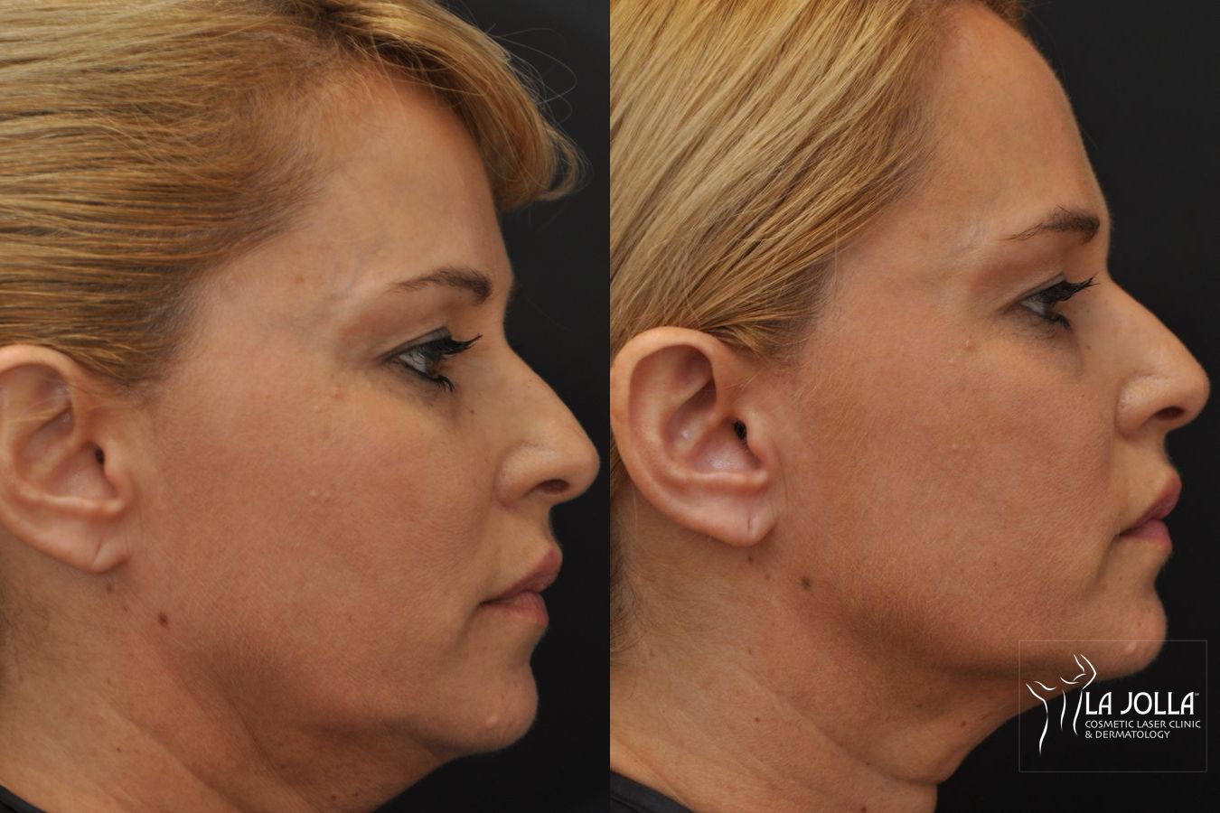 Before and after Ultherapy® case 36195