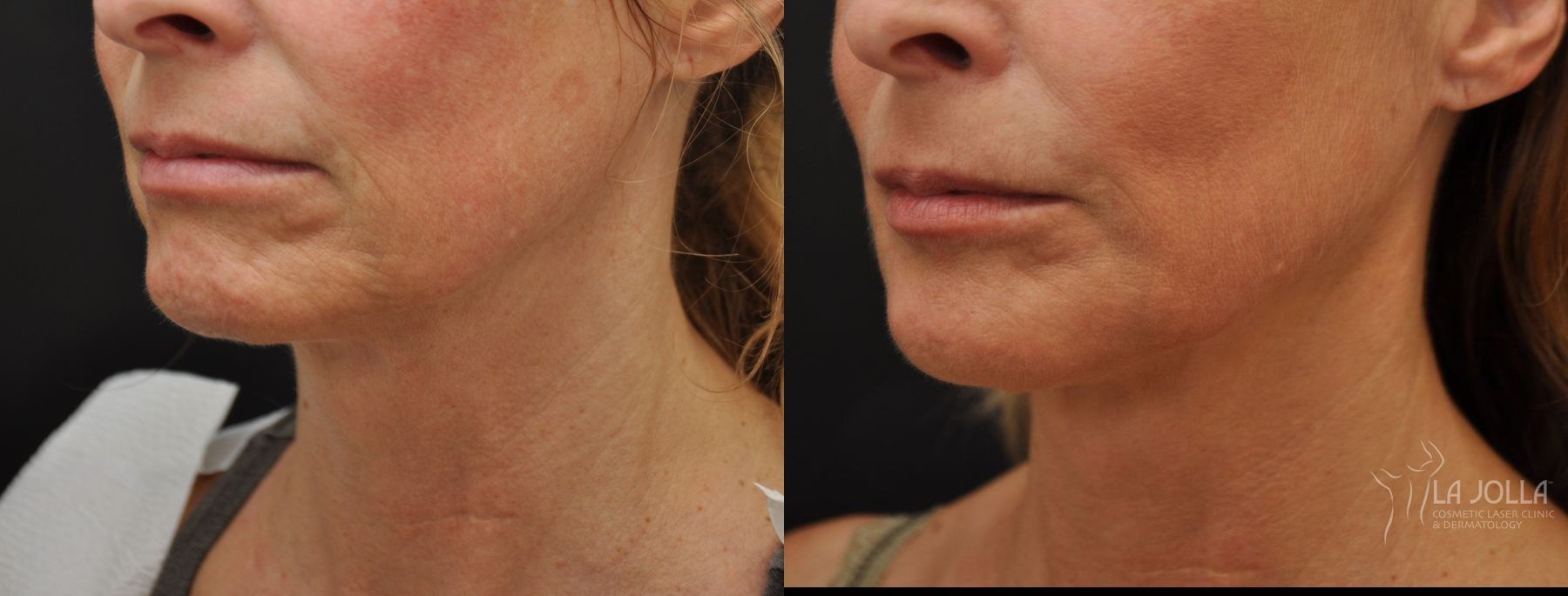 Before and after Ultherapy® case 36209