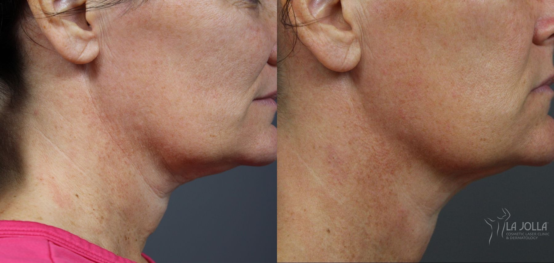 Before and after Ultherapy® case 36073