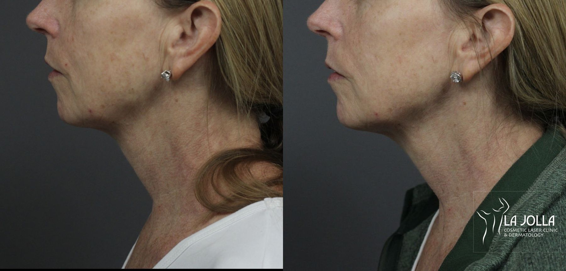 Before and after Ultherapy® case 36105