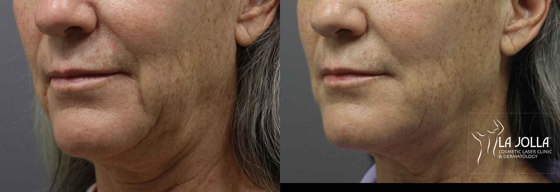 Before and after Ultherapy® case 36229