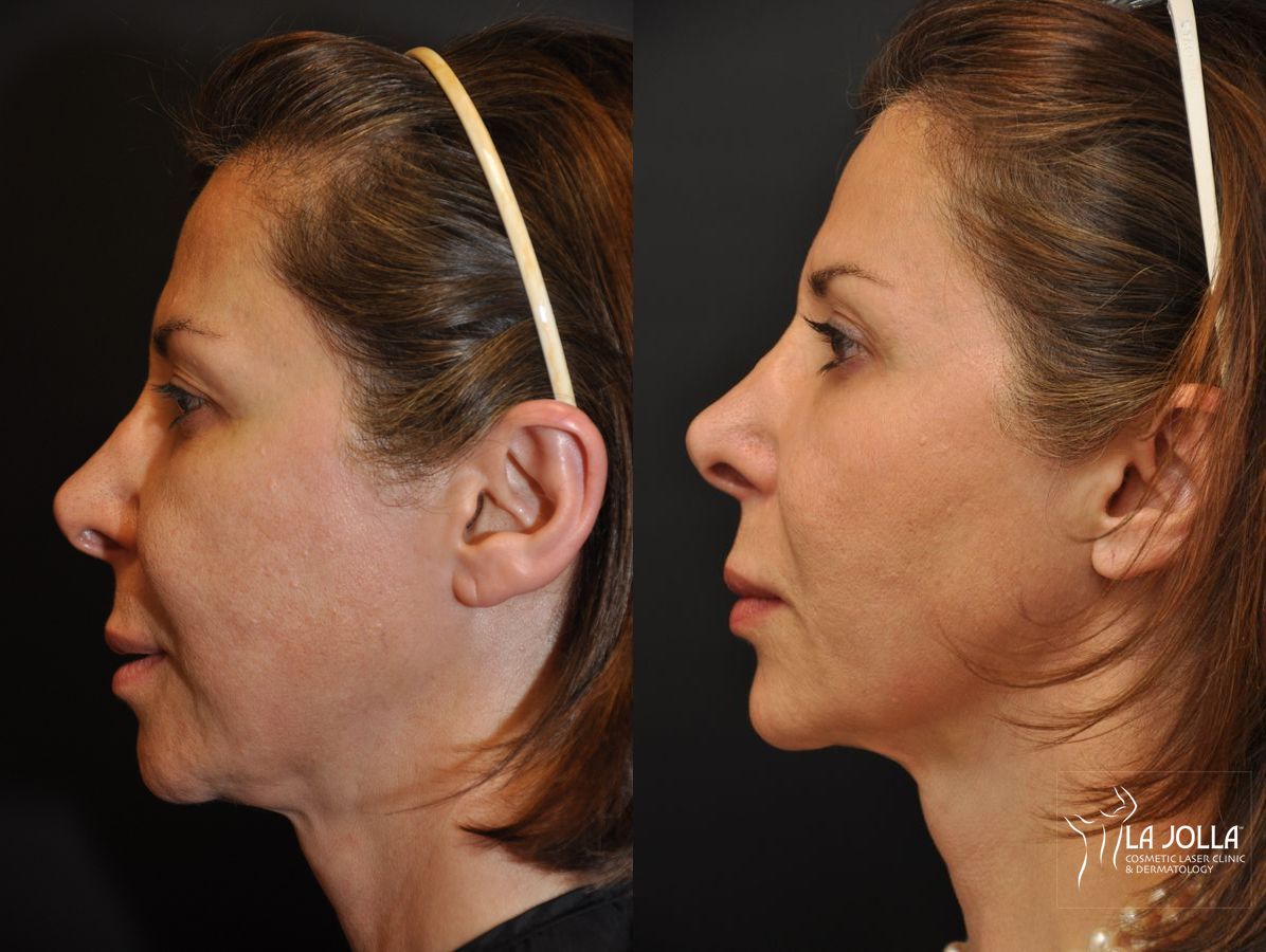 Before and after Ultherapy® case 36175