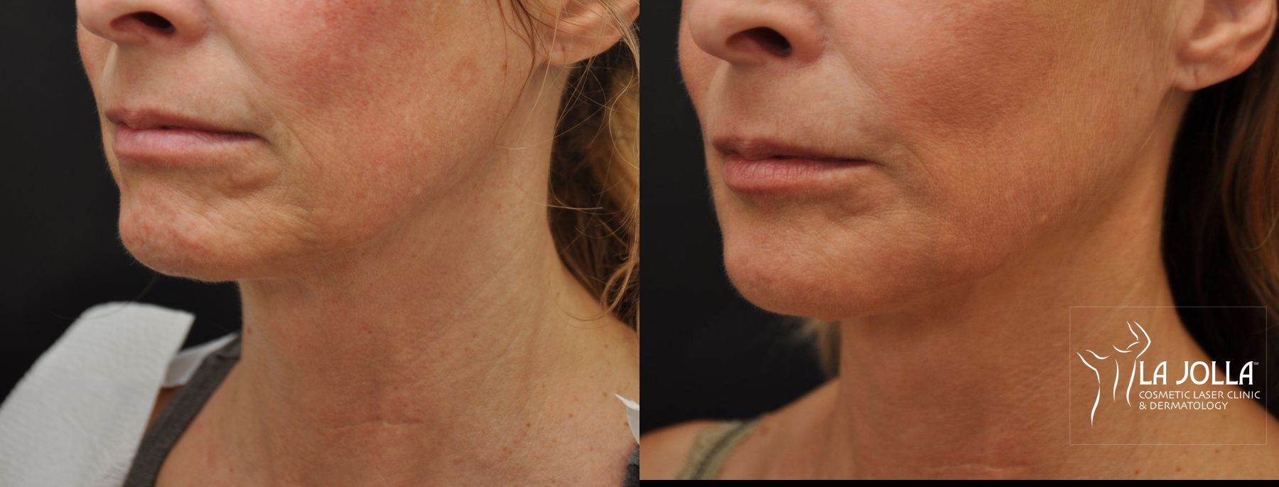 Before and after Ultherapy® case 36209