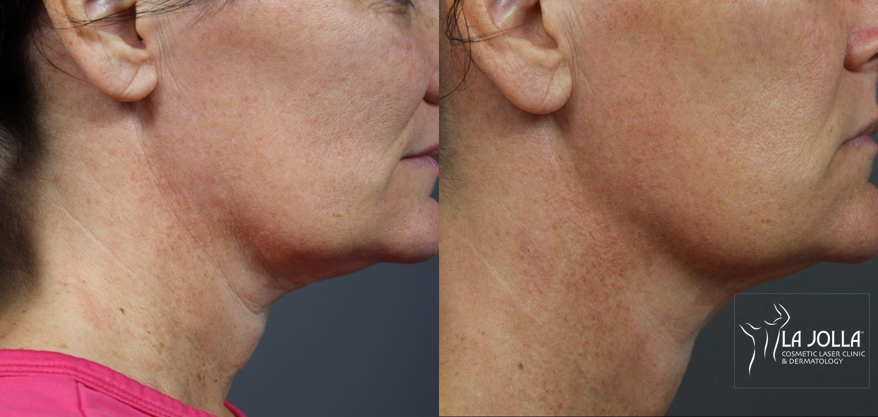 Before and after Ultherapy® case 36073