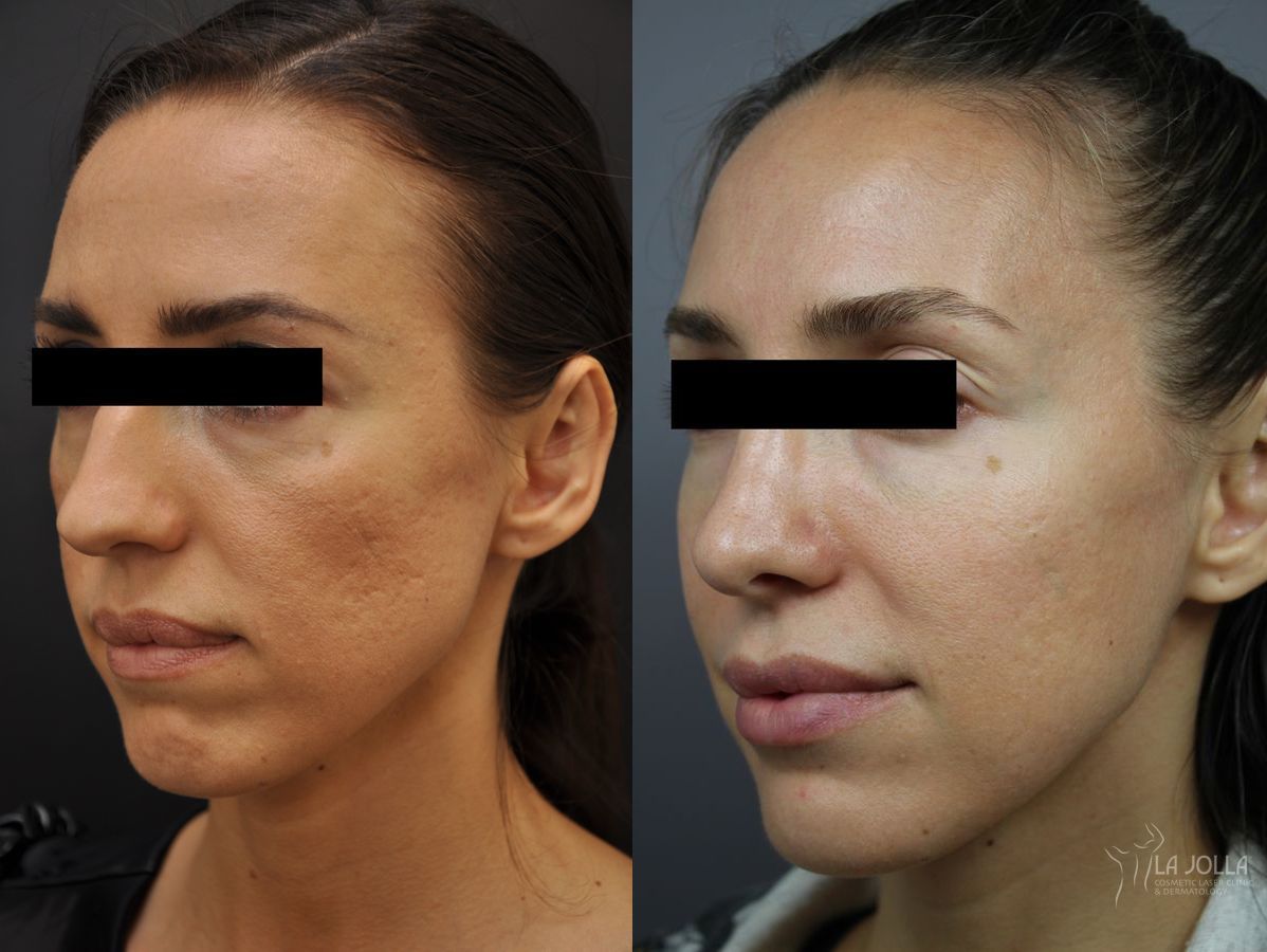 Before and after Under Eye Filler case 36408