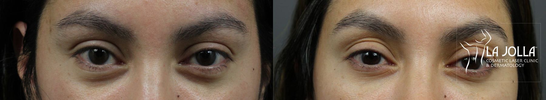 Before and after Under Eye Filler case 36427