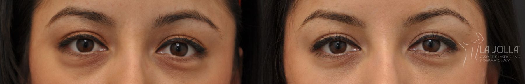 Before and after Under Eye Filler case 36428