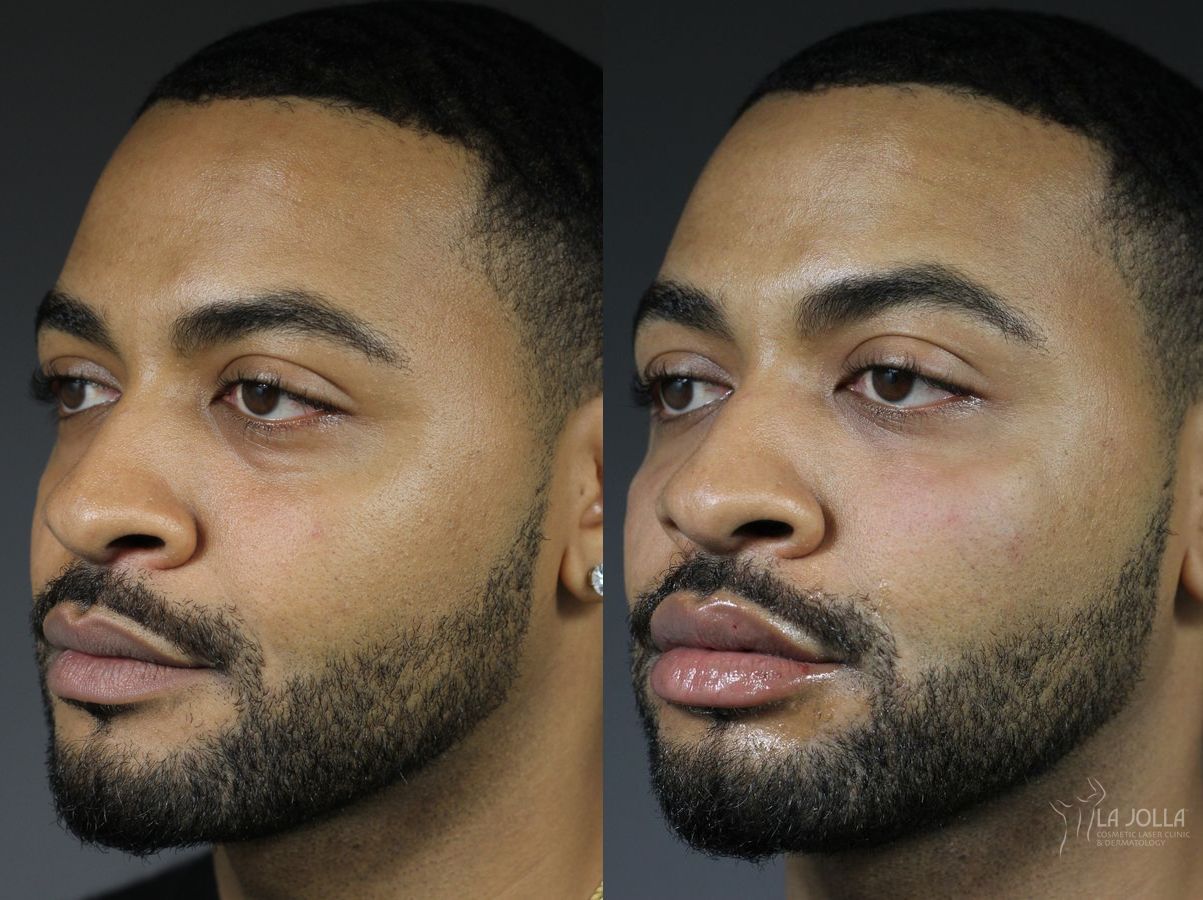 Before and after Under Eye Filler case 36439