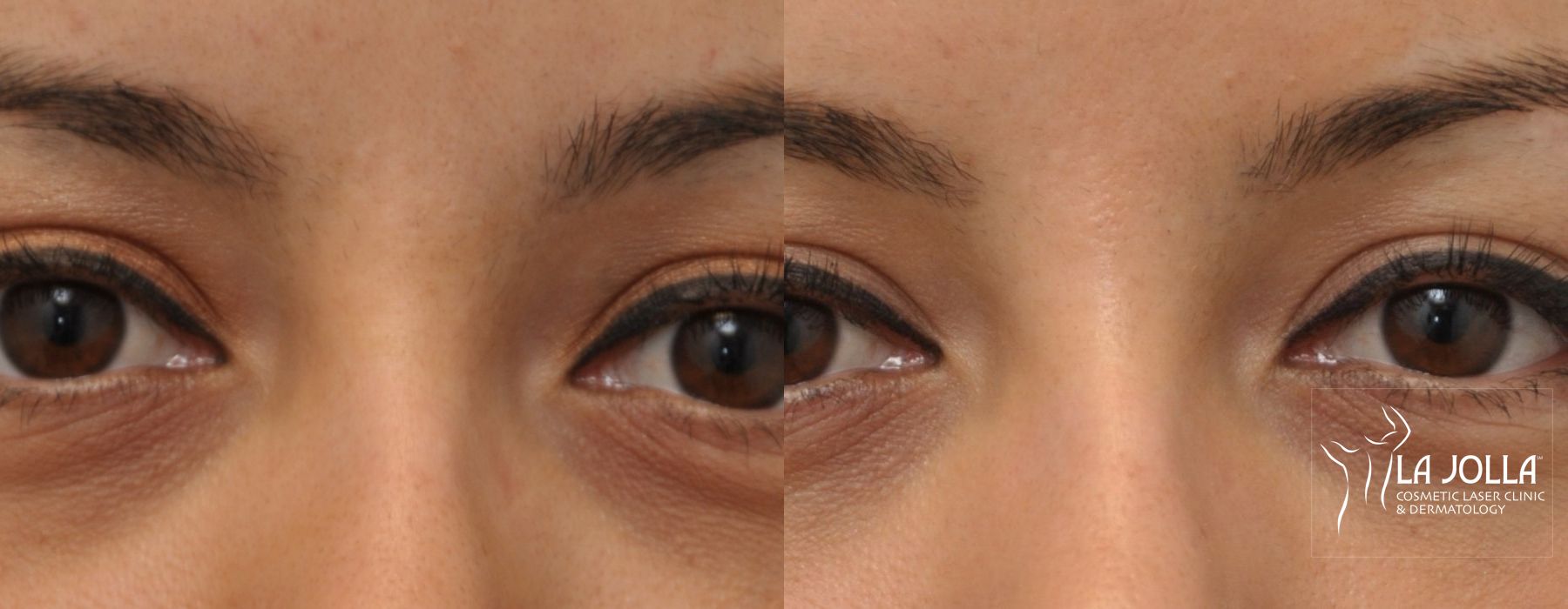 Before and after Under Eye Filler case 36428