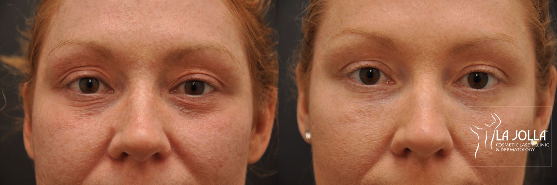 Before and after Under Eye Filler case 36425