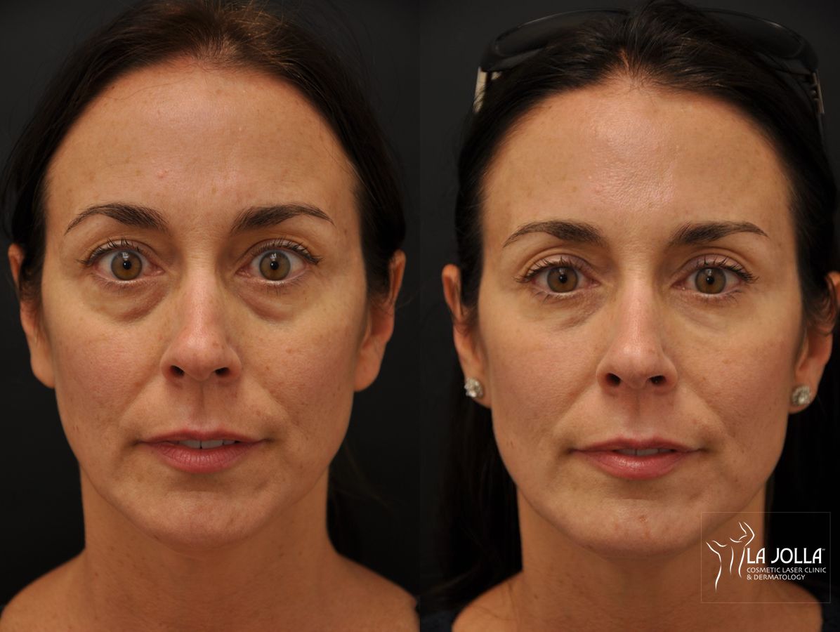 Before and after Under Eye Filler case 36432