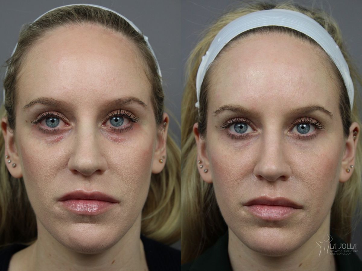 Before and after Under Eye Filler case 36409