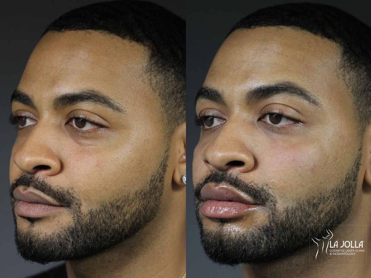 Before and after Under Eye Filler case 36439