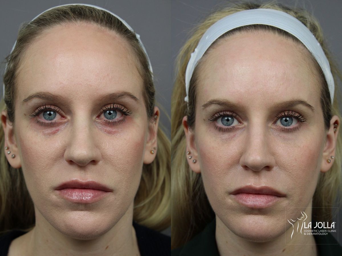 Before and after Under Eye Filler case 36409