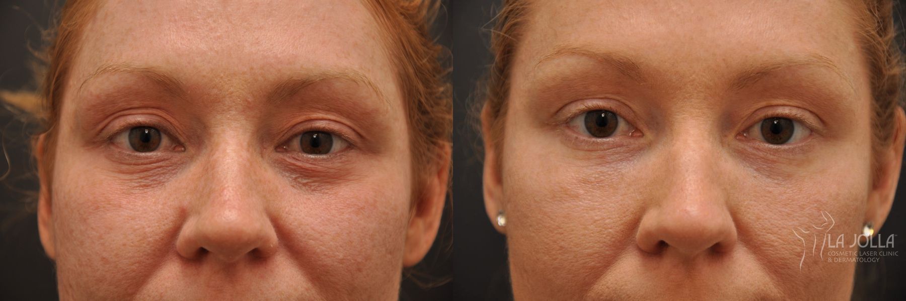 Before and after Under Eye Filler case 36425