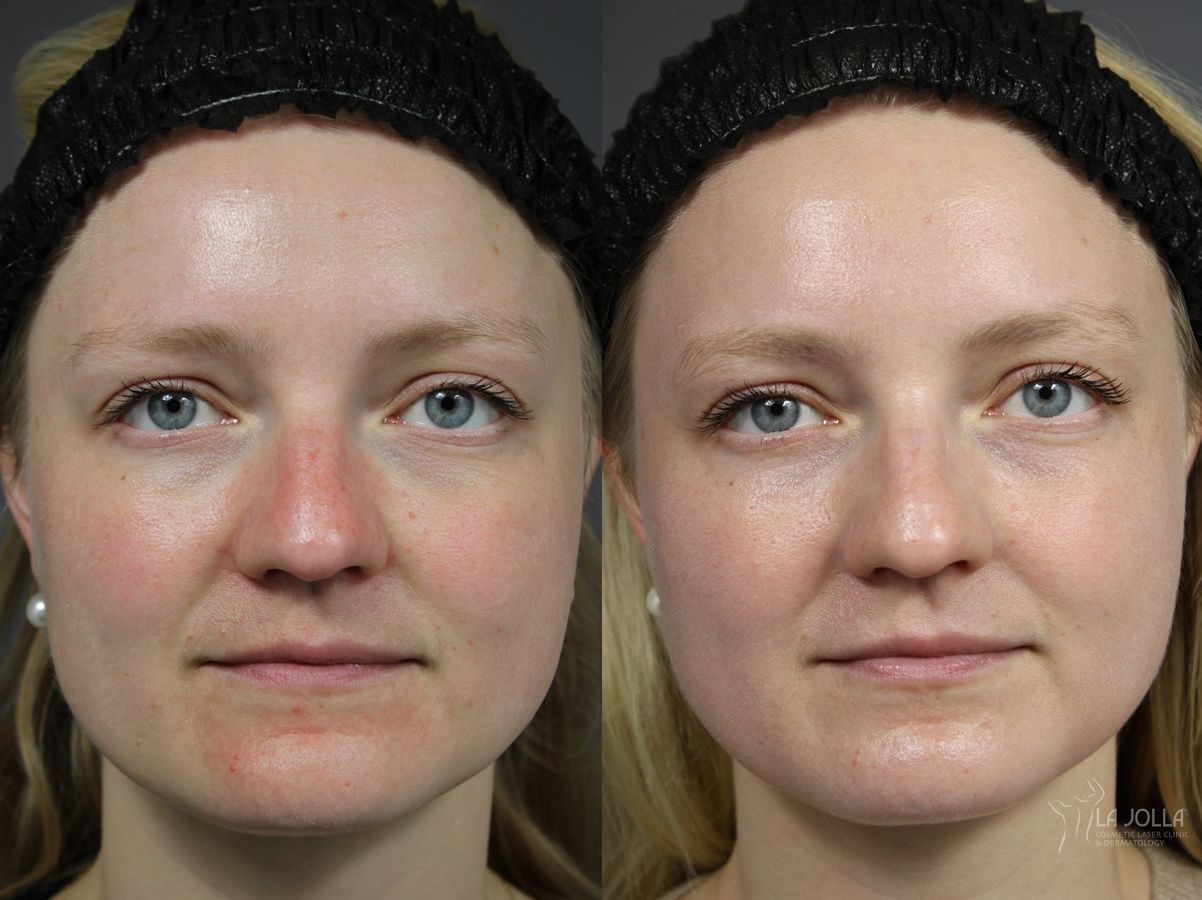 Before and after VBeam case 36150