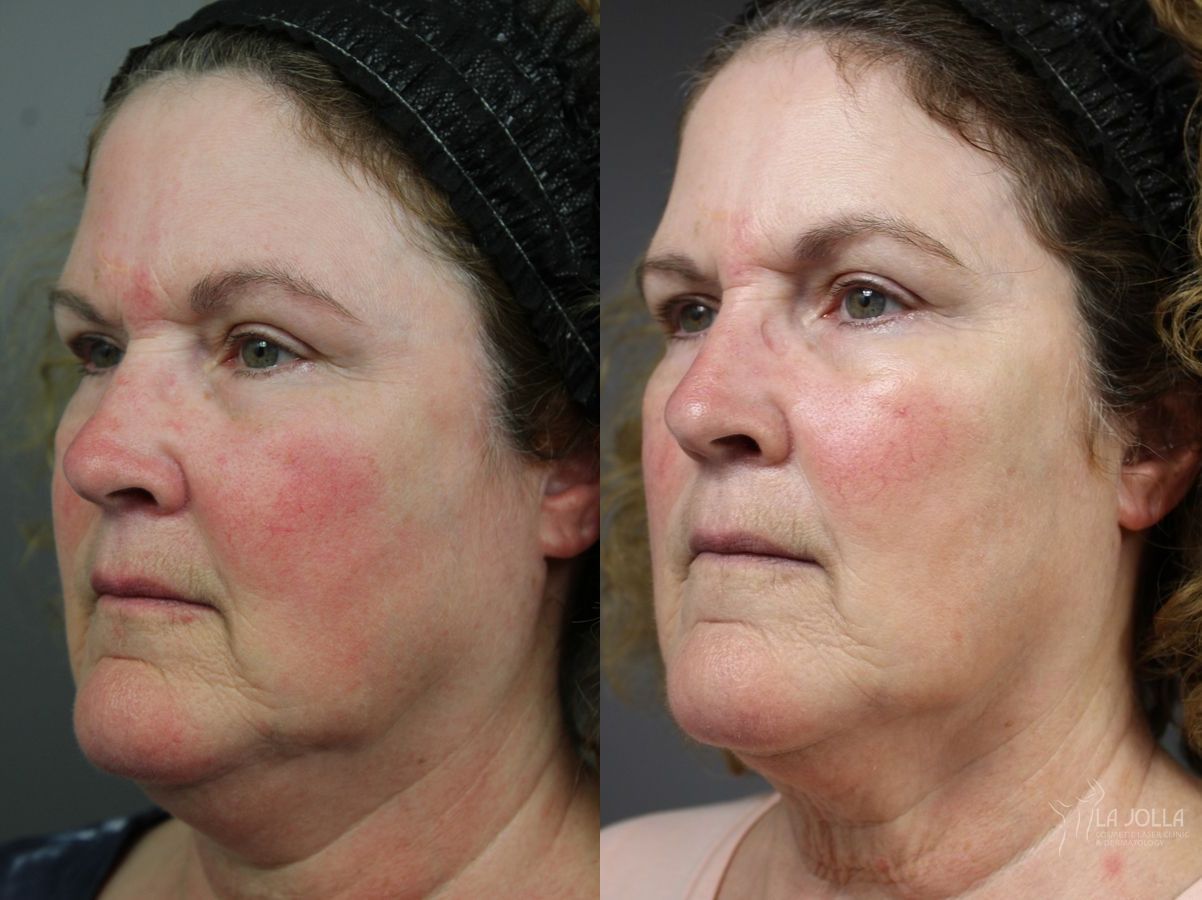 Before and after VBeam case 36121 - Angle 3