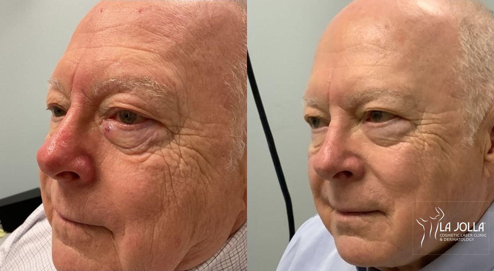 Before and after VBeam case 36169 - Angle 2