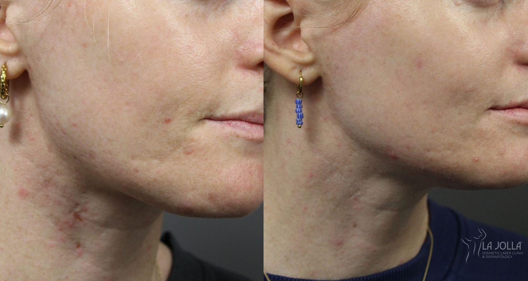 Before and after VBeam case 36085
